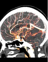 Flow Diversion Aneurysm Treatment Market Analysis North America, Europe, Asia, Rest of World (ROW) - US, UK, Germany, Canada, China - Size and Forecast 2024-2028