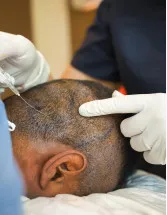 Hair Transplant Market Analysis North America, Europe, Asia, Rest of World (ROW) - US, China, Germany, Canada, India - Size and Forecast 2024-2028