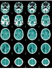 Non-Invasive Intracranial Pressure Monitoring Devices Market Analysis North America, Europe, Asia, Rest of World (ROW) - US, UK, Germany, China, Japan, Canada, Mexico, France, India, Brazil - Size and Forecast 2025-2029