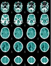 Non-Invasive Intracranial Pressure Monitoring Devices Market Analysis North America, Europe, Asia, Rest of World (ROW) - US, UK, Germany, China, Japan, Canada, Mexico, France, India, Brazil - Size and Forecast 2025-2029