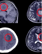 Hydrocephalus Shunts Market by Product and Geography - Forecast and Analysis 2022-2026