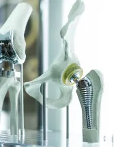 Femoral Prostheses Market Analysis North America, Europe, Asia, Rest of World (ROW) - US, Germany, China, France, Canada - Size and Forecast 2024-2028