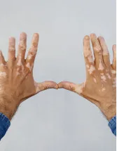 Vitiligo Therapeutics Market Analysis Growth, Trends and Regional Forecast 2024-2028