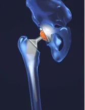 Bone Replacement Market Analysis North America, Europe, Asia, Rest of World (ROW) - US, Germany, UK, China, Japan - Size and Forecast 2024-2028