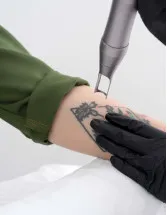 Tattoo Removal Market Analysis North America, Europe, APAC, South America, Middle East and Africa - US, China, Germany, Canada, UK - Size and Forecast 2024-2028