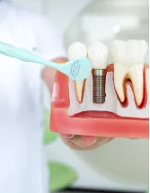 Dental Implants Market Analysis China - Size and Forecast 2024-2028