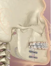 Distraction Osteogenesis Devices Market Analysis North America, Europe, Asia, Rest of World (ROW) - US, Germany, UK, China, Japan - Size and Forecast 2024-2028