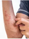 Systemic Psoriasis Therapeutics Market Analysis North America, Europe, Asia, Rest of World (ROW) - US, Norway, Kazakhstan, UK, Germany, Philippines, India, Canada, Brazil, Spain - Size and Forecast 2024-2028