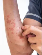 Systemic Psoriasis Therapeutics Market Analysis North America, Europe, Asia, Rest of World (ROW) - US, Norway, Kazakhstan, UK, Germany, Philippines, India, Canada, Brazil, Spain - Size and Forecast 2024-2028